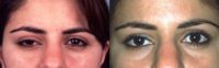 Upper eyelid ptosis surgery