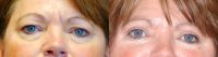 Upper lower eyelift/blepharoplasty