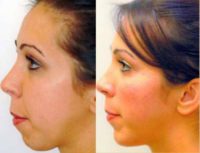 Woman treated with Chin Surgery