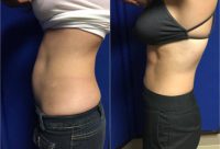 Woman treated with CoolSculpting
