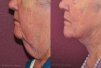 Woman treated with Neck Lift