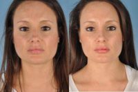 Woman treated with Revision Rhinoplasty