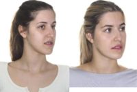 18-24 year old woman treated with Jaw Surgery