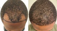 18-24 year old man treated with FUE Hair Transplant