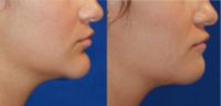 18-24 year old woman treated with Cheek Augmentation