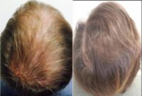 18-24 year old man treated with Hair Transplant