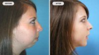 18-24 year old woman treated with Orthognathic Surgery