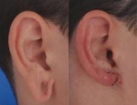 18-24 year old man with gauge piercing treated with Ear Surgery