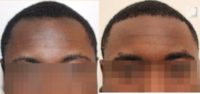 25-30 year-old patient treated with FUE Hair Transplant : Black hair / curly hair results