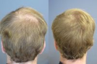 25-34 year old man treated with Scalp Micropigmentation