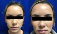 25 year old woman treated with Dysport + Restylane Lyft