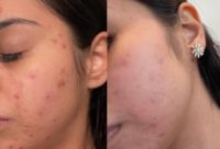25-34 year old woman treated with Glycolic Peel