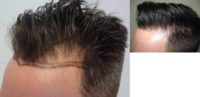 25-34 year old man treated with ARTAS Robotic Hair Transplant