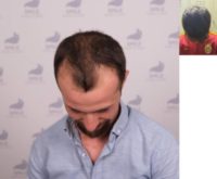 25-34 year old man treated with FUE Hair Transplant, Hair Transplant, Hair Loss Treatment, Hair Loss, Hair Restoration, Smile Ha