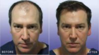 25-34 year old man treated with Hair Transplant
