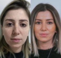 25-34 year old woman treated with Chin Implant, Revision Rhinoplasty and My Bişekto Surgery