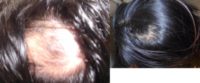 25-34 year old woman treated with PRP for Hair Loss