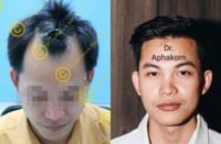 30 year old man treated with FUE Hair Transplant for Frontal Hairline Restoration (AGA class III)