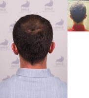 25-34 year old man treated with FUE Hair Transplant, Hair Transplant, Hair Loss Treatment, Hair Loss, Hair Restoration, Smile Ha