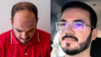 25-34 year old man treated with DHI (CHOI PENS) Hair Transplant