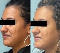 25-34 year old woman treated with Laser Resurfacing
