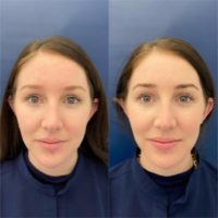 25-34 year old woman treated with Voluma