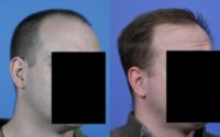 32 year old man treated with FUE Hair Transplant