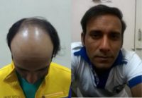 25-34 year old man treated with Hair Transplant