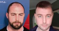 25-34 year old man treated with FUE Hair Transplant