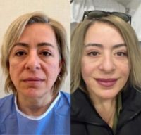 25-34 year old gender nonconforming person treated with Facelift, Neck Lift