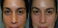 25-34 year old woman treated with VI Peel