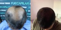 34 year old man treated with DHI Hair Transplant