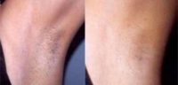 25-34 year old woman treated with Laser Hair Removal