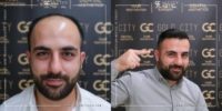 35-44 year old man treated with FUE Hair Transplant, Hair Transplant