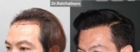 35-44 year old man treated with Hair Transplant