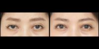 35-44 year old woman treated with Ptosis Surgery, Eyelid Surgery