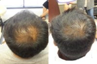 35-44 year old man treated with Propecia for Hair Loss