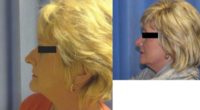 35-44 year old woman treated with Rhinoplasty