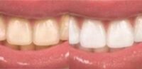 35-44 year old woman treated for teethe whitening