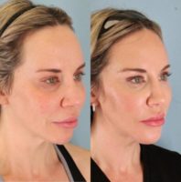 35-44 year old woman treated with Chin Implant, Platysmaplasty & Microliposuction