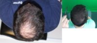 35-44 year old man treated with Hair Transplant