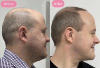 35-44 year old man treated with Hair Transplant, FUE Hair Transplant, Hair Loss Treatment