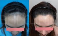 35-44 year old woman treated with FUE Hair Transplant