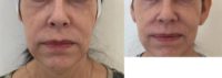 35-44 year old woman treated with Sculptra Aesthetic
