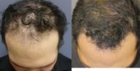 43 year old man treated with Hair Transplant