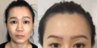 35-44 year old woman treated with Thread Lift and Ellanse in my Yuan Yang Lift technique