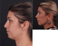 35-44 year old woman treated with Facial Fat Transfer