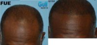 45-54 year old male treated with FUE Hair Transplant