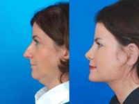45-54 year old woman treated with Facelift and Chin Surgery