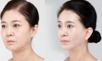 45-54 year old woman treated with SMAS Facelift